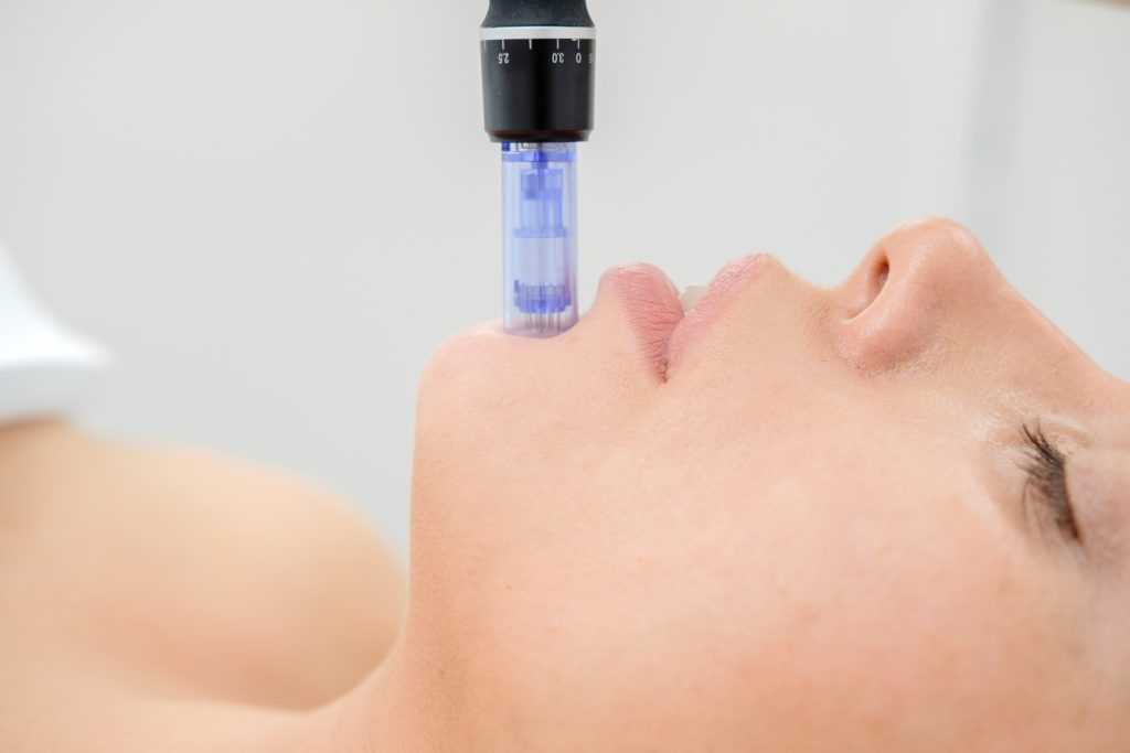 microneedling